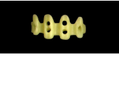 Cod.E2 f Upper Anterior: 10x  hollow pontics blocks-frames, (12-22), carved to fit into wax veneers Cod.E2Upper Anterior, LARGE, broad cervix, (13-23), for porcelain pressed to metal bridgework